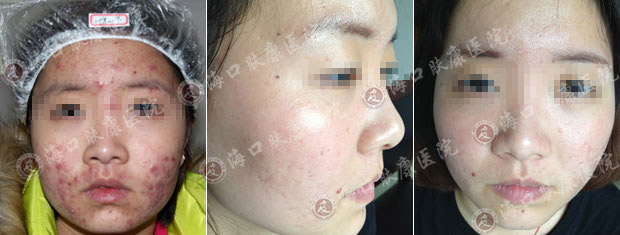 暑期祛痘受学生追捧 肤康提醒:祛痘提前网络预约 看诊快人一步